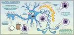 Characterization of recombinant IFN β-1b and elucidation of its role as a therapy/regimen against Multiple Sclerosis